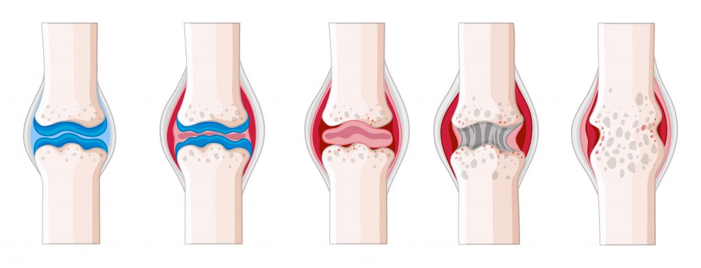 An illustration of joints affected by rheumatoid arthritis.