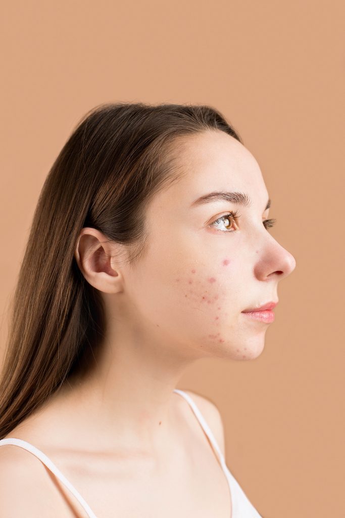 A close-up shot of a woman displaying her acne, indicating that sugary foods contribute to acne development.