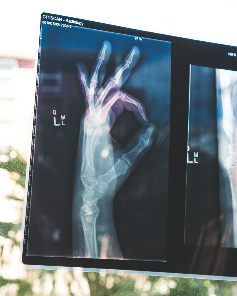 An X-ray film showing healthy hand bones, illustrating the positive impact of garlic intake on bone health.