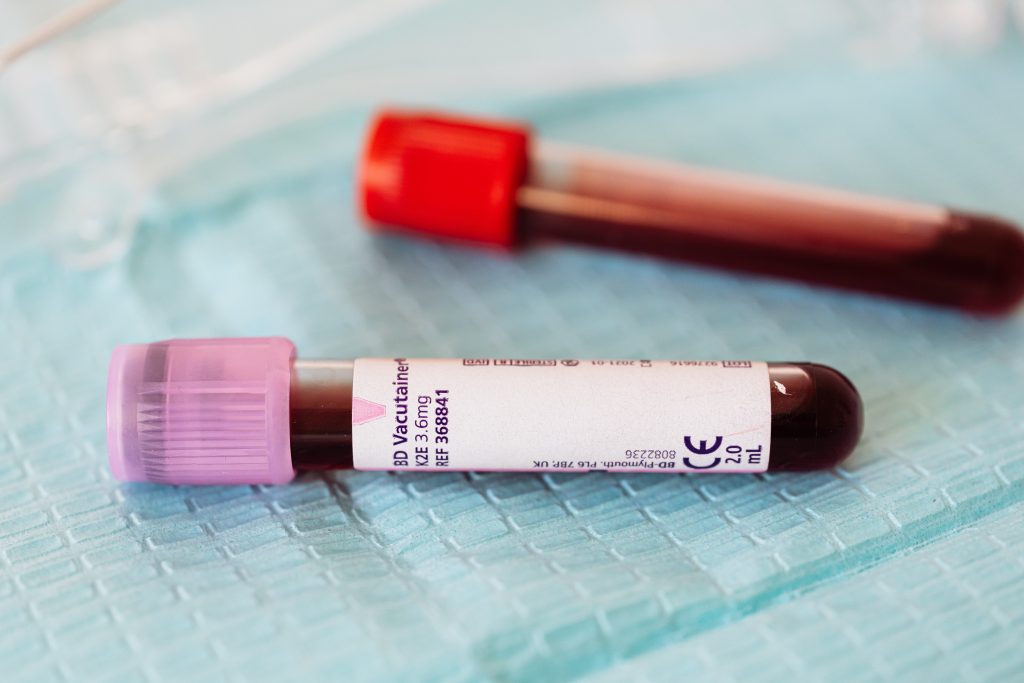 Two test tubes on a tray show that B12 deficiency should be checked with a blood count and serum B12 level.