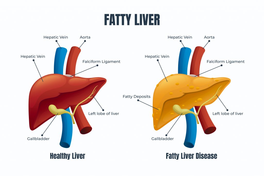 A comparison of a healthy liver and a fatty liver, emphasizing the fatty deposits in the unhealthy liver.