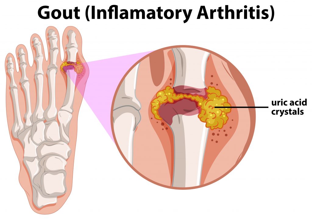 Vector image of Gout (Inflammatory Arthritis) affecting the big toe joint with uric acid crystal buildup causing pain and swelling.