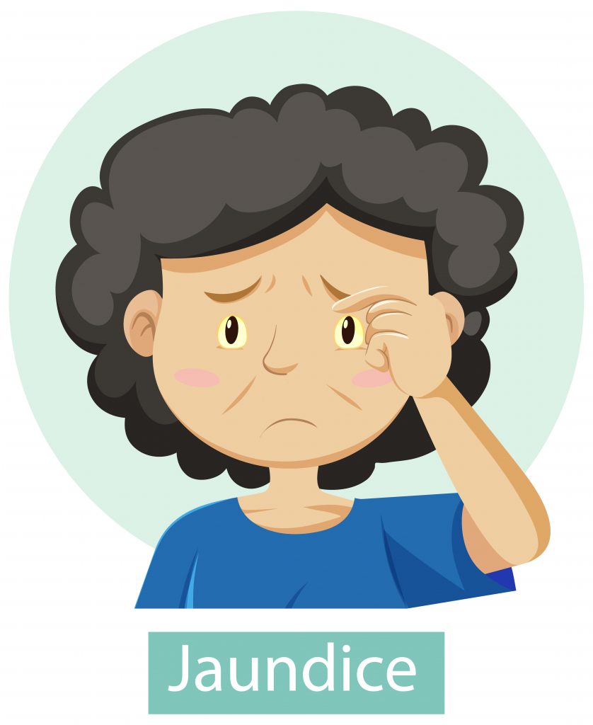 A vector image of a person with yellow eyes and a blue shirt, labeled with the word "Jaundice".