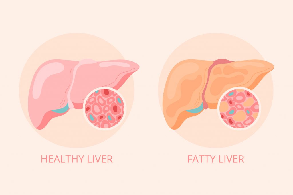 Comparison of healthy and fatty liver cross-sections, emphasizing differences in liver tissue.