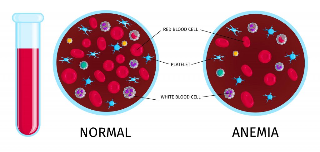 Comparison of normal blood and blood with anemia, showing red and white blood cells, and platelets.