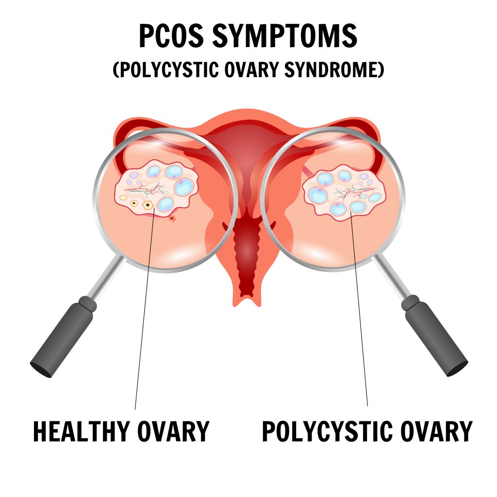 Enlarged view of ovaries with multiple cysts, depicting polycystic ovary syndrome (PCOS).