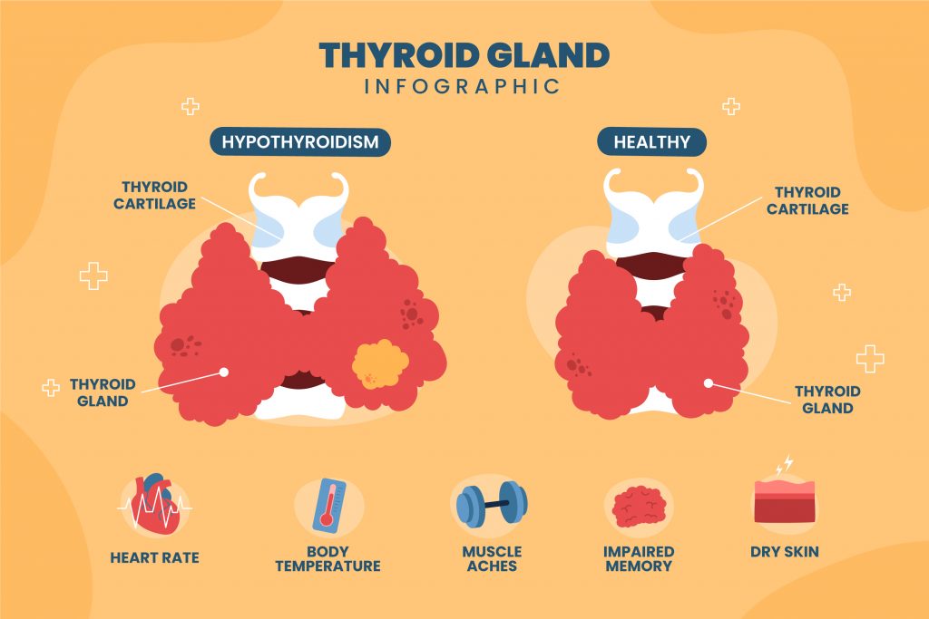 Infographic illustrating the differences between a healthy thyroid gland and one with hypothyroidism.