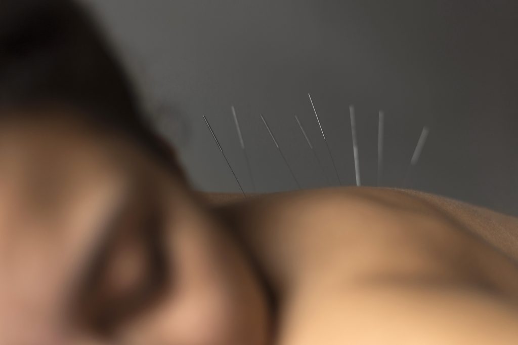A woman undergoing acupuncture therapy for fibromyalgia, with fine needles gently inserted along her back.